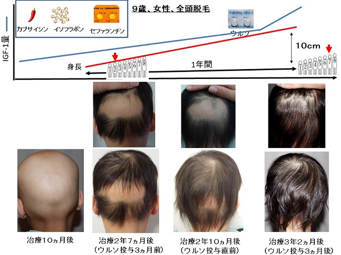 円形脱毛症　病院